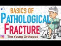 Pathological FRACTURE, Causes, Treatment, Mirel's Score, NEET PG, USMLE, The Young Orthopod