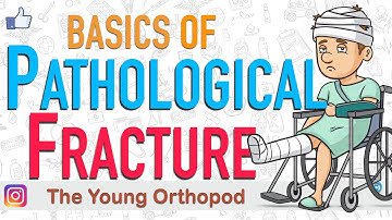 Pathological FRACTURE, Causes, Treatment, Mirel