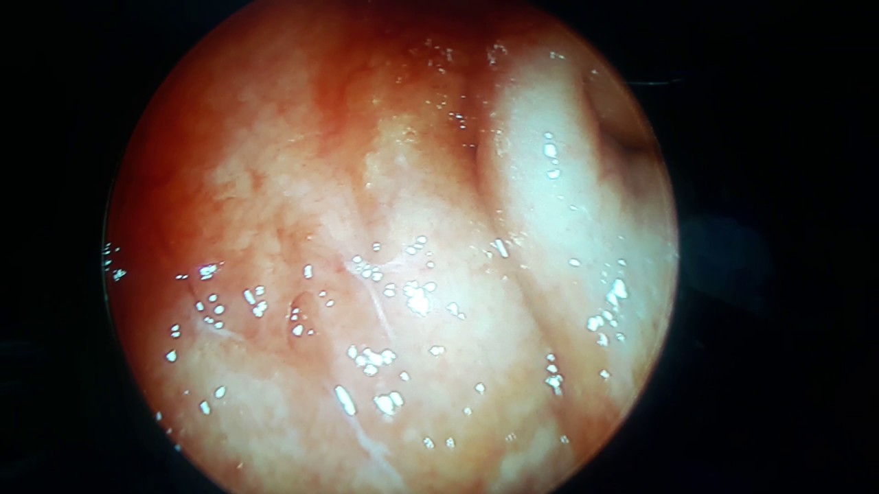 Is Eustachian Tube Balloon Dilation Covered By Insurance Is Eustachian Tube Balloon Dilation Covered By Insurance