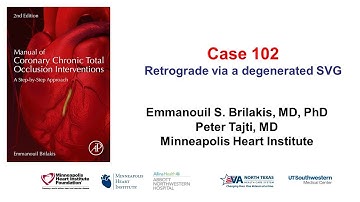 Case 102: Manual of CTO Interventions: Retrograde CTO PCI via degenerated SVG