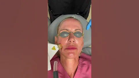 Intense Pulsed Light Treatment for Dark Spots