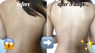 HOW TO GET RID OF BACNE IN LESS THAN 1 WEEK | Ybeth Rosario