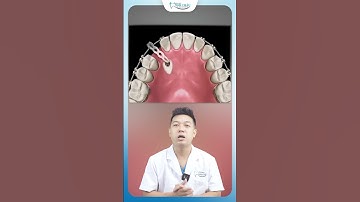 Quá Trình Kéo Răng Ngầm Ra Khỏi Hàm | Nha Khoa Minh Châu