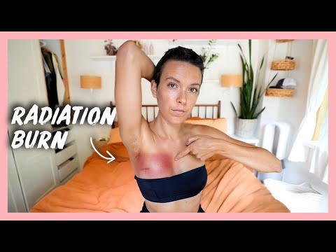 I had radiation for breast cancer