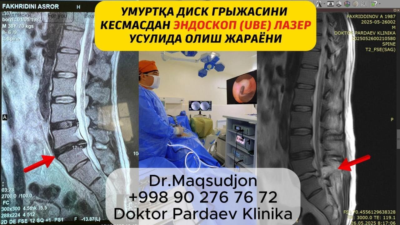 УМУРТҚА ДИСК ГРЫЖАСИНИ КЕСМАСДАН ЭНДОСКОП (UBE) ЛАЗЕР  УСУЛИДА ОЛИШ ЖАРАЁНИ  +998 90 276 76 72