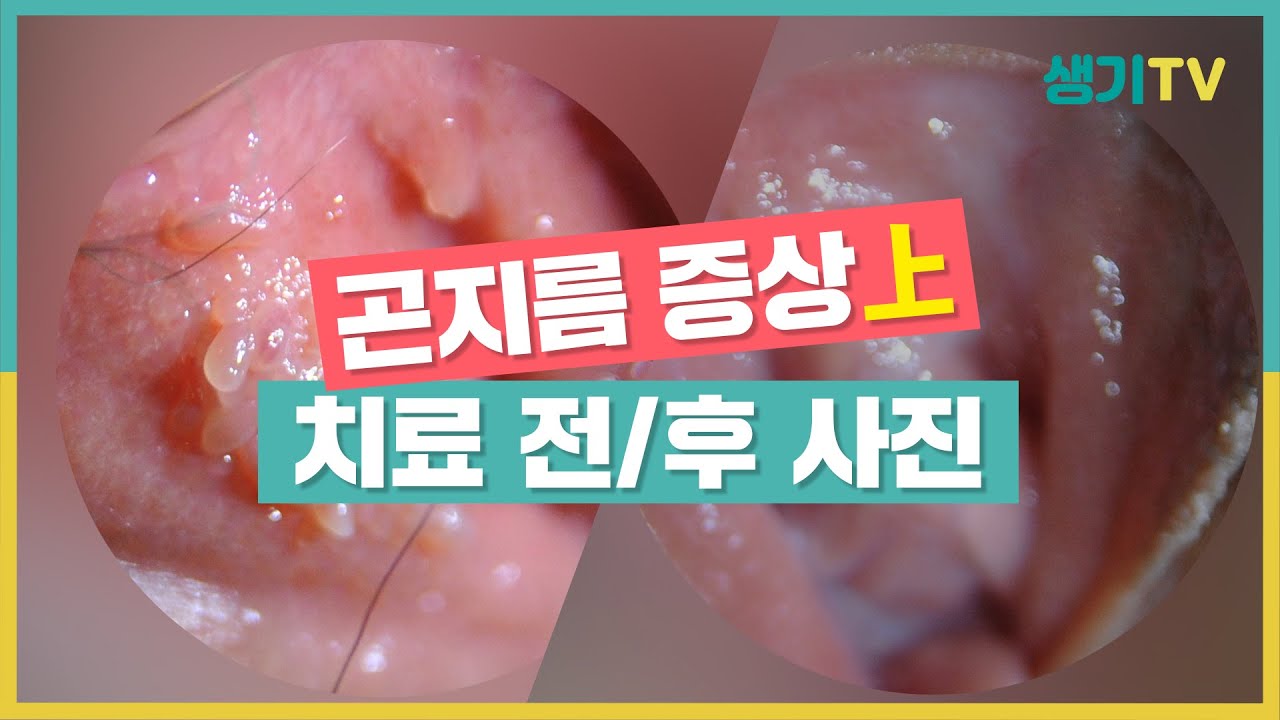 Hpv 바이러스는 뿌리를 뽑아야 재발하지 않아요!(Feat. 곤지름 전후사진) - Youtube