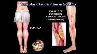 Vascular Claudication or Sciatica  Everything You Need To Know  Dr. Nabil Ebraheim