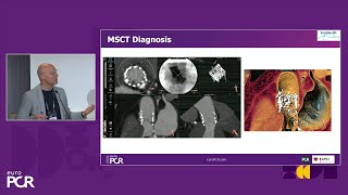 Identification and treatment of (sub)clinical transcatheter valve thrombosis - EuroPCR 2024 by PCR 159 views 6 days ago 1 hour, 3 minutes