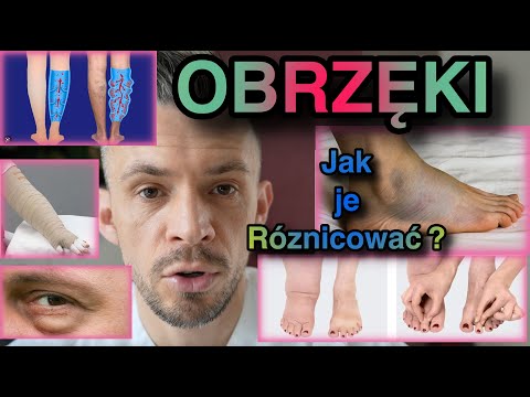 Wideo: Co to jest obrzęk lipy i obrzęk limfatyczny?