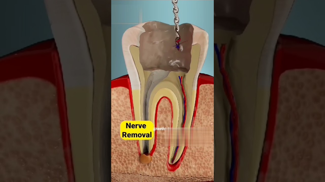 RCT/root canal treatment 3d animation 