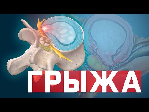 Позвоночная грыжа. Грыжа диска. Что делать? Как лечить?