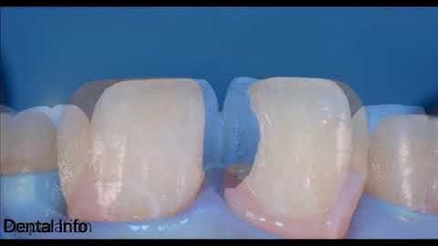 Class IV Restoration ( Full Video )