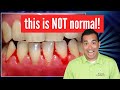 Bleeding Gums Are NOT Normal | Debunking 10 Dental Myths