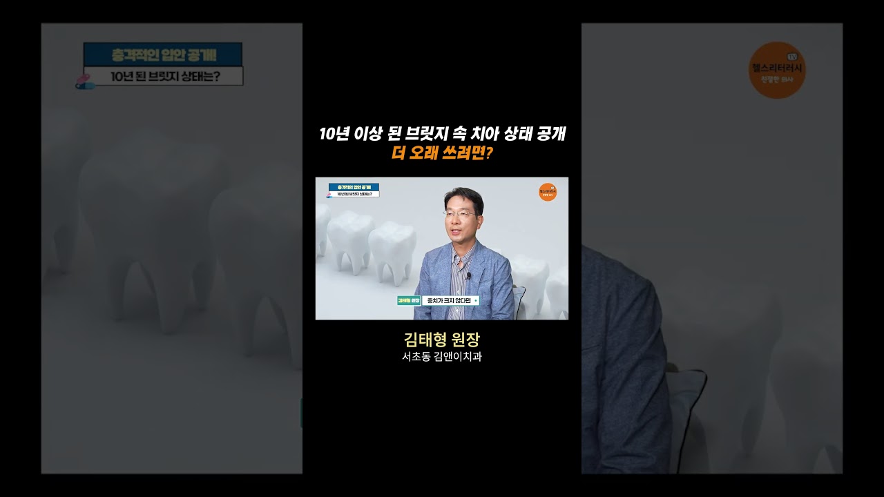 10년 이상된 브릿지 속 치아 상태 공개, 더 오래 쓰려면?