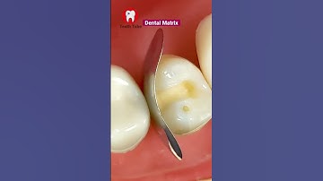 Dental Matrix #shorts