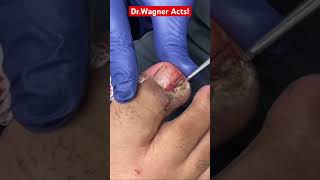 A DINOSAUR INGROWN TOENAIL REMOVAL🦖#shorts