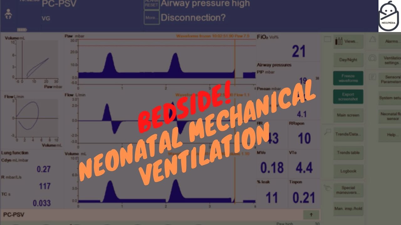 Bedside! Neonatal Mechanical ventilation.