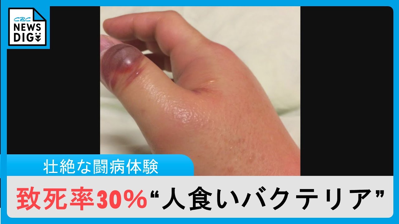 人 喰い バクテリア 写真