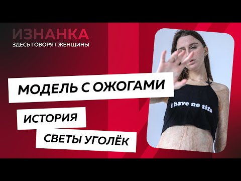 Video: Sveta Ugolek: Model With Burns Over 45% Of The Body