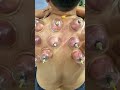 ​Shoulder Pain? Cupping Therapy का जादू देखें! #shorts #cupping #neurotherapy #doctor
