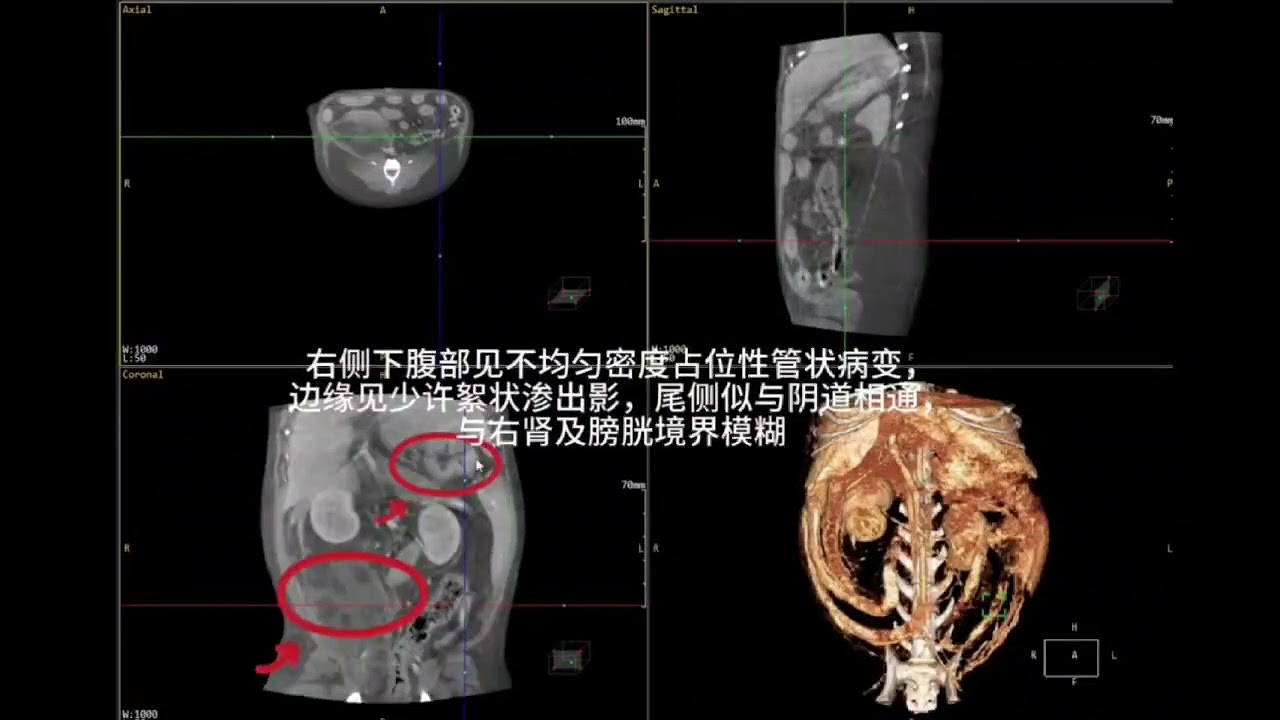 Case Briefing of Peritonitis Triggered by Abscess of Residue Uterus Scanned by Gemstone Vet CT