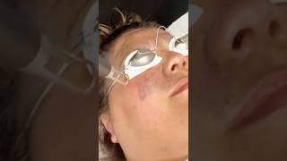 ? Rescuing Skin from Laser Acne Burns? skincare asmr satisfying  laseracne acnetreatmentface