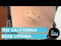 The California Bear Lipoma