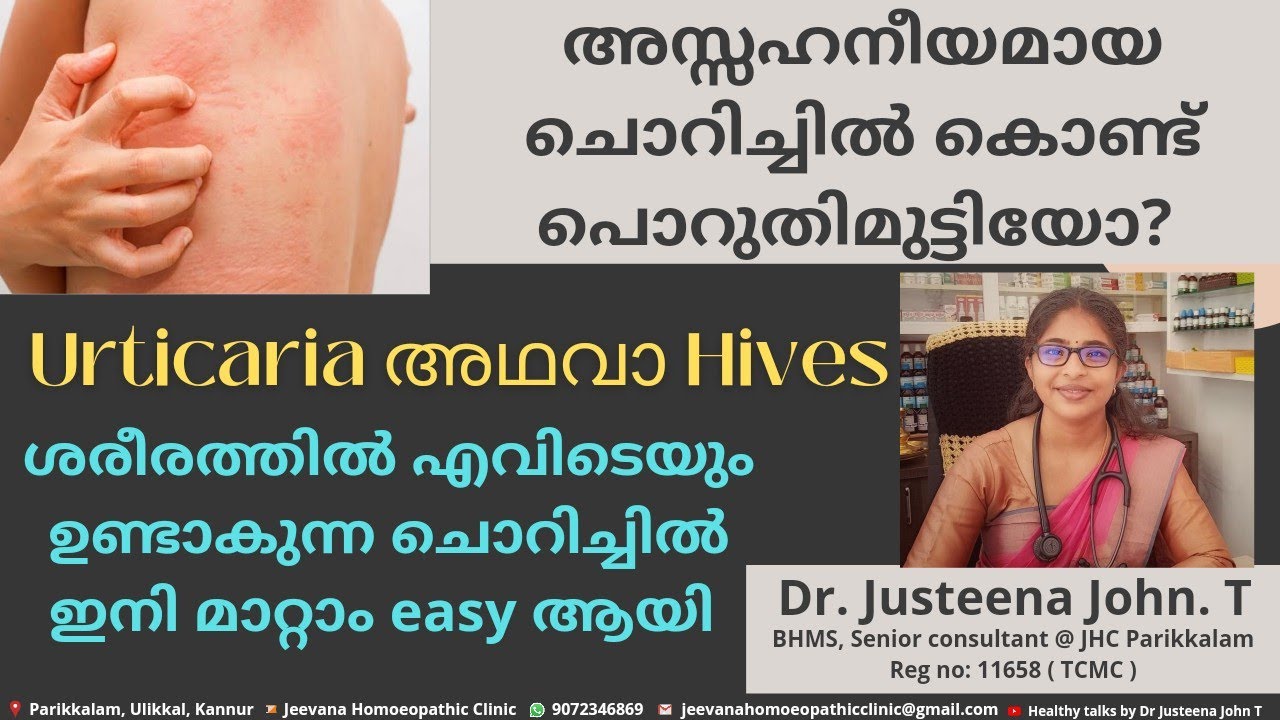 urticaria അഥവാ hives |എന്തുകൊണ്ട് ഉണ്ടാവുന്നു | ചൊറിച്ചിൽ മാറ്റം നാച്ചുറലായി | Dr Justeena John T