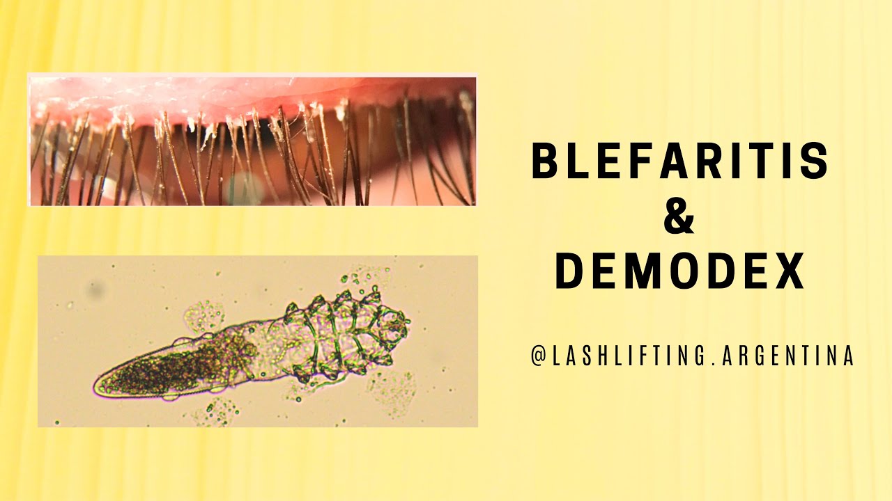 Blefaritis y Demodex #liftingdepestañas #lashlifting 