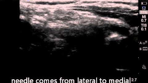 ULtrasound guided superficial cervical plexus block