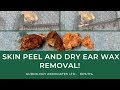 SKIN PEEL AND DRY EAR WAX REMOVAL - EP 174