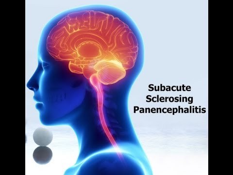 Subacute sclerosing panencephalitis (SSPE)