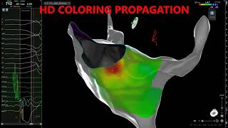 WPW ABLATION.