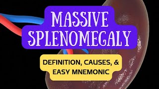 Massive Splenomegaly - Easy Mnemonic