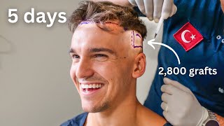 I got a hair transplant in Turkey