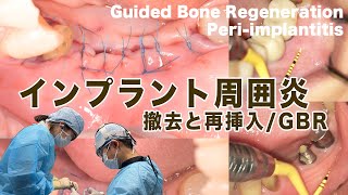 インプラント失敗例！インプラント周囲炎に対する撤去/再埋入