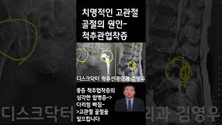 고관절 골절을 일으키는 척추관 협착증 디스크탈출증 비수술적추치료 양방향척추내시경김영우 척추신경외과 김영우 허리통증 목디스크 우리들병원 연세사랑병원#shorts