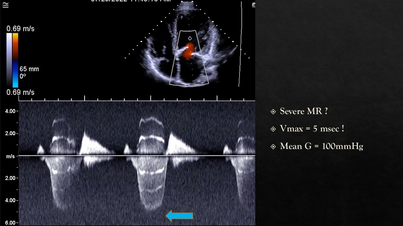 Tiger stripes in human heart? echocardiographic sign YouTube