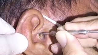 Massive Earwax Removed from Man and Woman's Ear by Earwax Specialist 135,982 views 3 months ago 1 minute, 8 seconds