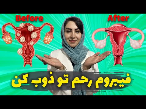 درمان قطعی فیبروم رحم در کمتر از 40 روز درمان فیبروم رحم بدون تزریق آمپول و جراحی