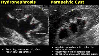 Difference Between Hydronephrosis & Renal Sinus/Parapelvic Cyst Ultrasound | Kidney USG Comparison