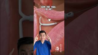Download Lagu Kamu pernah rasain 3 efek samping ini saat pakai Kb IUD? #youtubehealth #dokter #edukasi #viral MP3