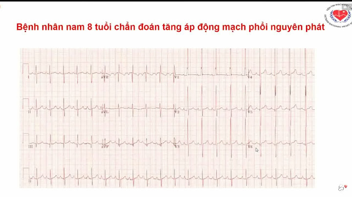 Hướng dẫn đọc rối loạn nhịp trên điện tâm đồ