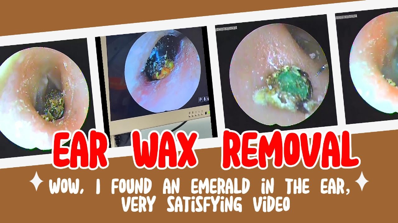 Wow, I found an emerald in my ear，what is it？ | ear wax removal ，very ...