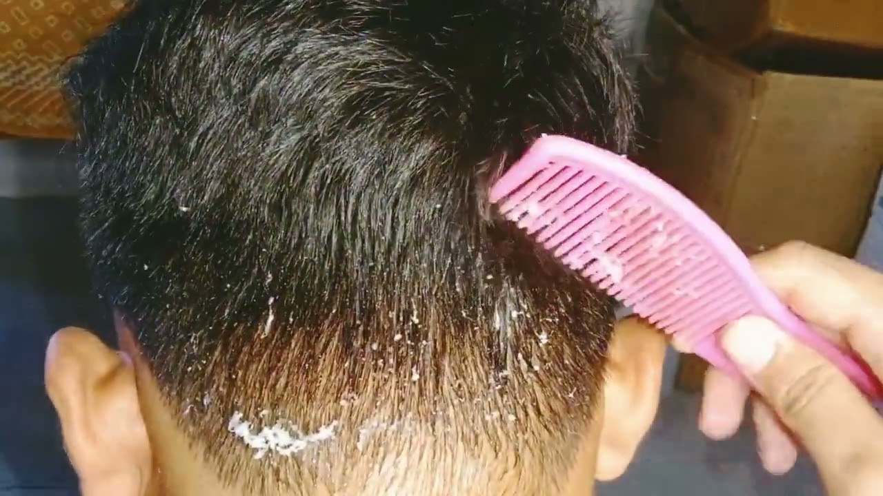 MY NECK IS PEELING PART 3 YouTube