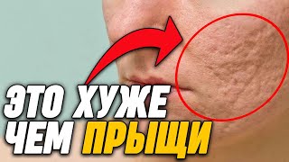 4 Вещи Которые ХУЖЕ Чем Прыщи!