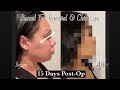 15 Days Post-Op Buccal Fat Removal &amp; Chin Lipo | Before And After |Recovery Update....♥️🥰