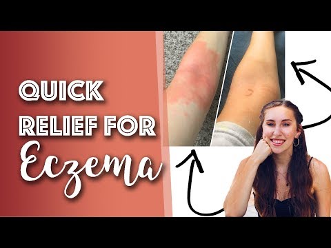 Como reduzir eczema no 3 horas! | O QUE FUNCIONA?