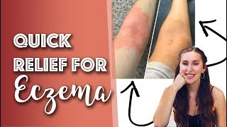 How to reduce eczema in 3 hours! | WHAT WORKS?