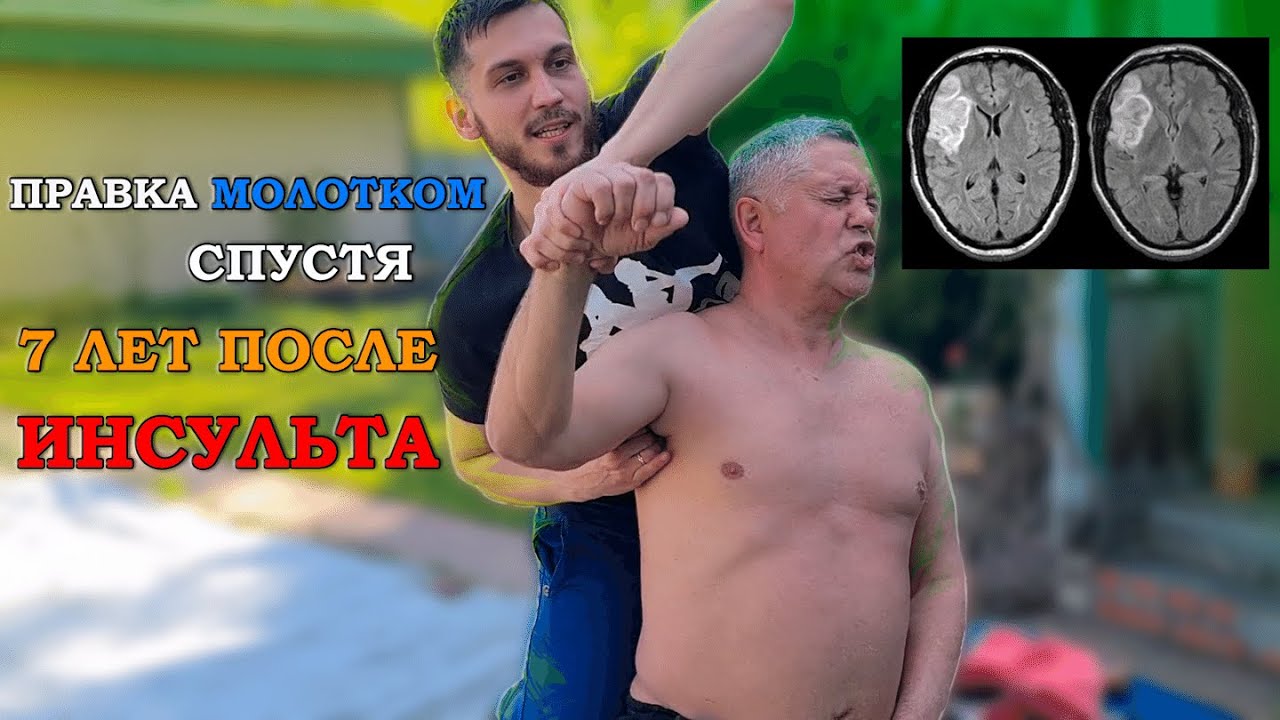 Правка дяде Ване/Костоправ убирает последствия инсульта - YouTube